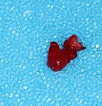 Molar apicectomy - Removed granulation tissue